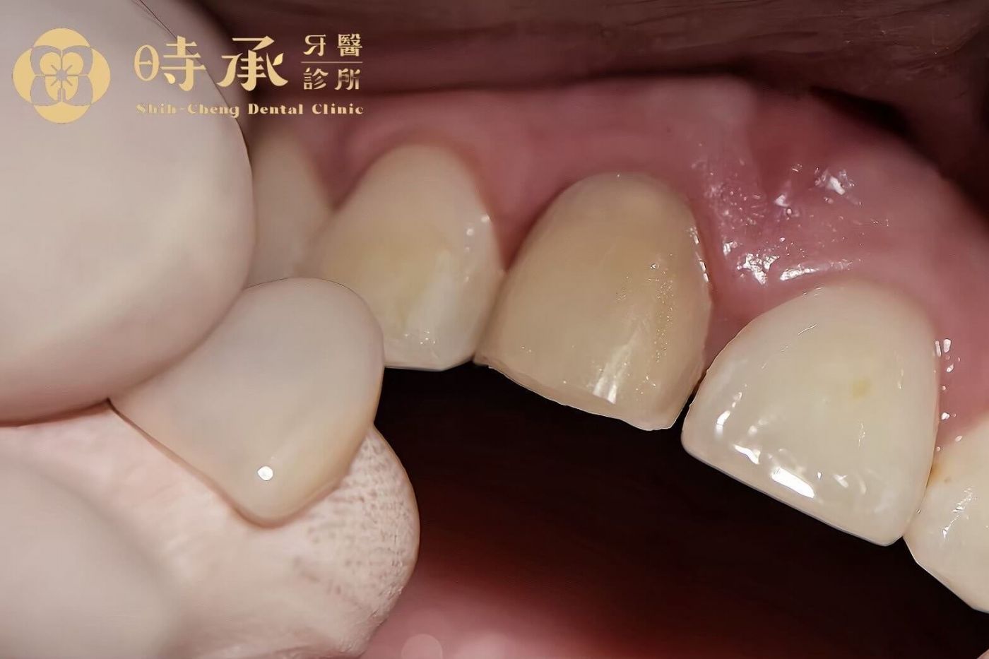 陶瓷貼片 vs 全瓷冠 vs 樹脂貼片:怎麼選對你的牙?