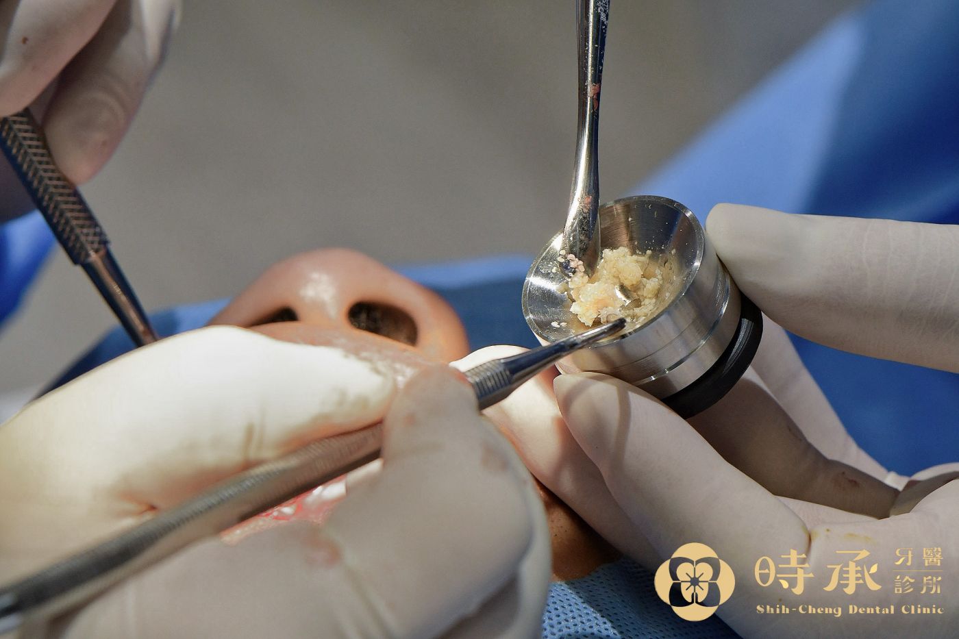 高雄植牙人工骨粉