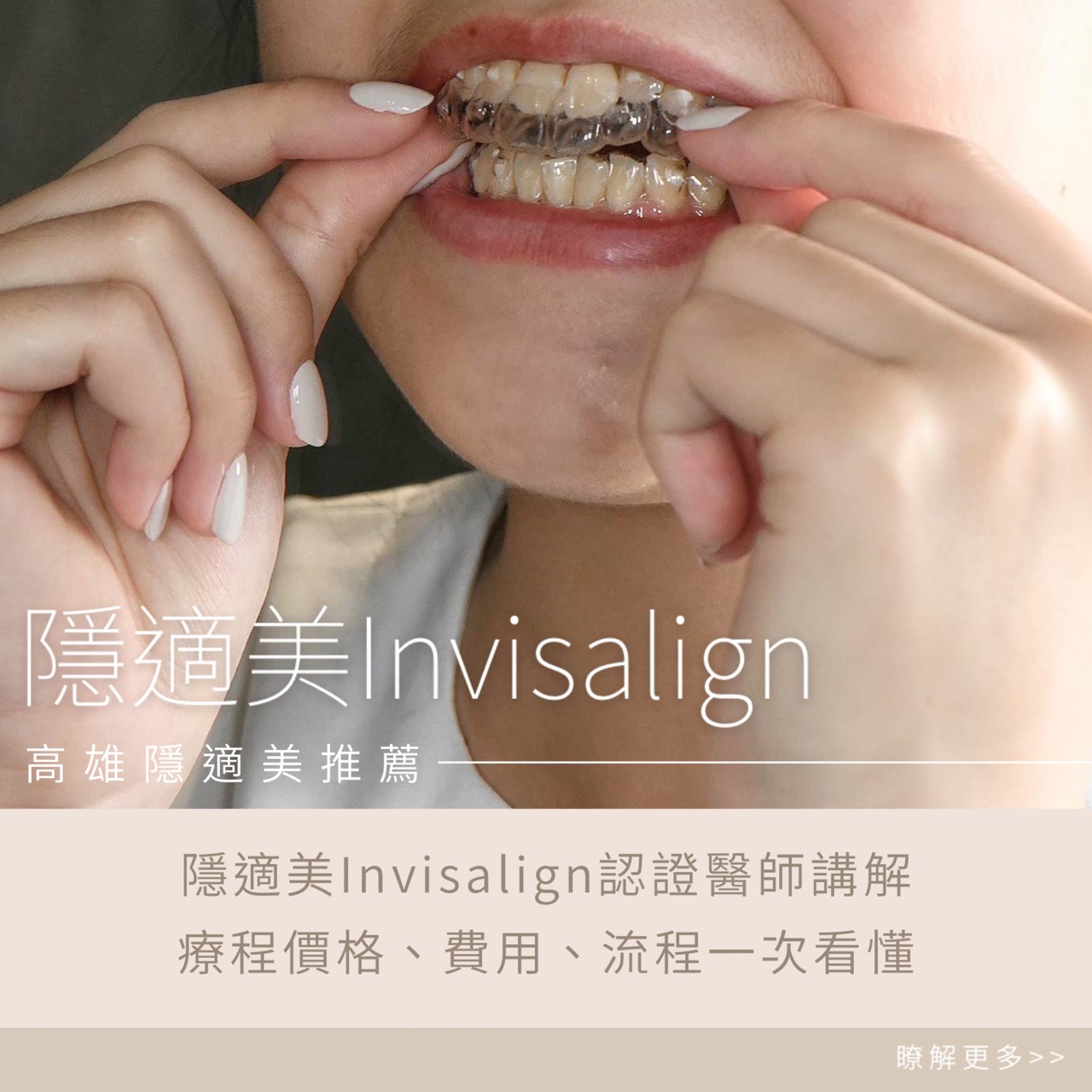 高雄隱適美推薦-認證醫師講解、價格費用、流程一次看懂