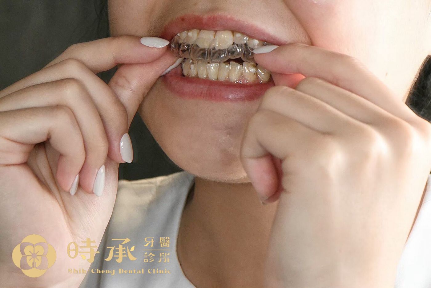 時承牙醫隱適美實務經驗分享